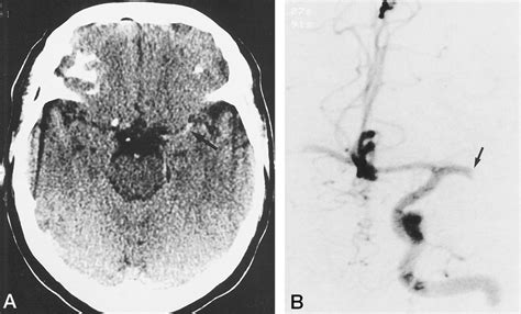 A Early Ct Scan Shows A Hyperdense Mca Sign Arrow On The Left 120