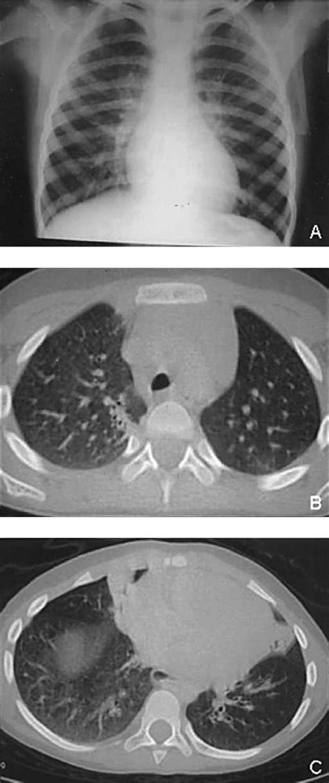 A 5 Year Old Girl With Asthma A Chest Radiography Does Not Show Any