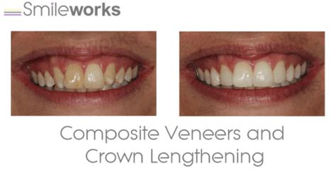 We did not find results for: Composite Bonding: Dentists compare the best (and worst ...