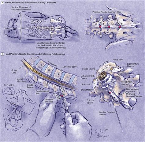 Performing A Lumbar Puncture Photo Journal Of The American Medical