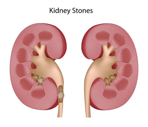 Kidney Stones Causes And Treatment Schemes Doctor Tipster