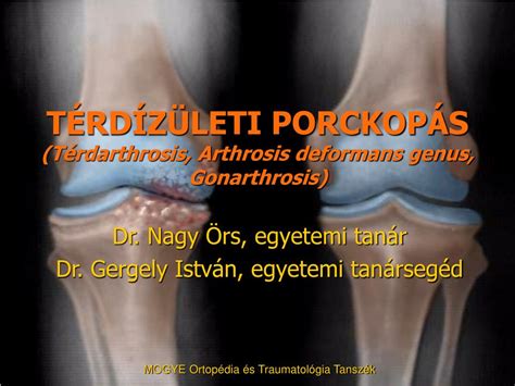 Gonarthrosis (térd osteoarthritis) - okai, tünetei, diagnózisa, kezelése - Osteopathia in