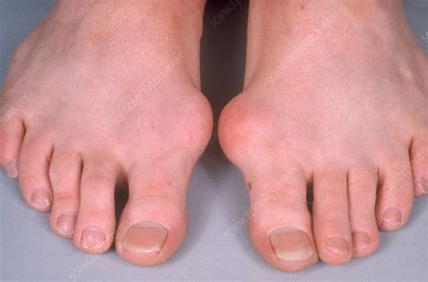 Gout Swelling Stock Image C0503955 Science Photo Library