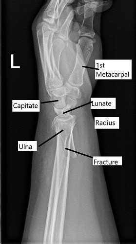 X Ray Wrist Lateral View