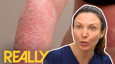 this is the worst case of psoriasis that dr emma has ever seen the bad skin clinic youtube