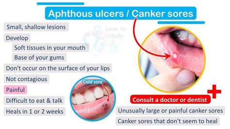 Aphthous Ulcers In 2021 Ulcers Canker Sore Cold Sore