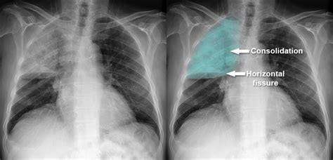 Chest X Ray Pulmonary Disease Consolidation Lobar