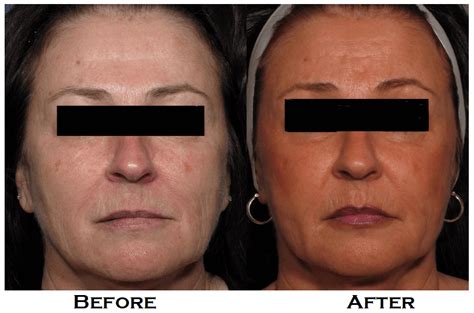 Facial Fat Transfer In Noblesvillein Zormeier Cosmetic Surgery