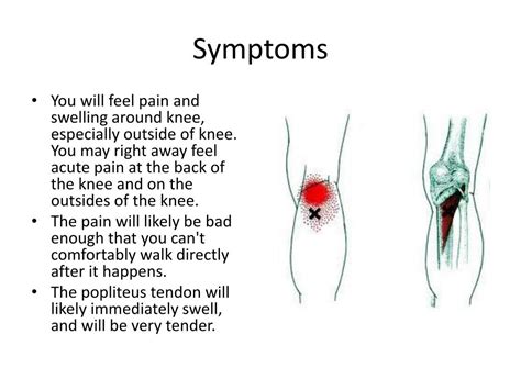 Popliteus Tendinopathy Muscle Tendon Injuries For Runners Santa Barbara Deep Tissue Riktr