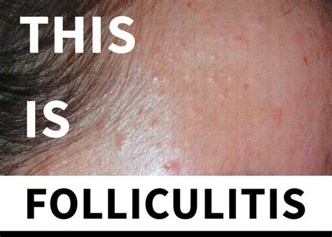 Malassezia Folliculitis Everything You Need To Know The