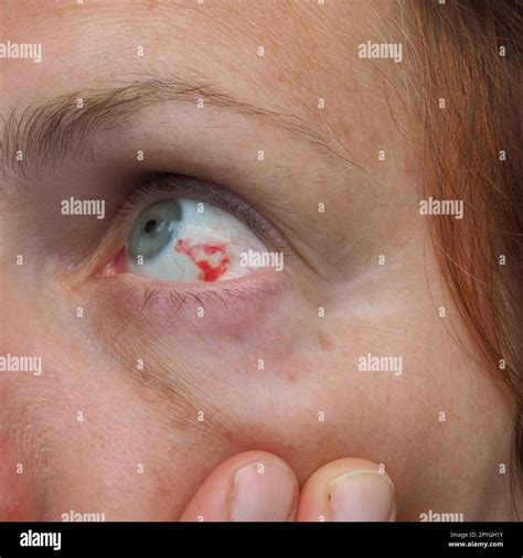 Eye Blood Vessel Hemorrhage SexiezPix Web Porn
