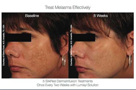 Transform Your Skin With Dermalinfusion In Chicago