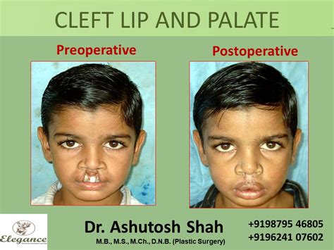 Cleft Lip And Palate Treatment Vadodara Gujarat India