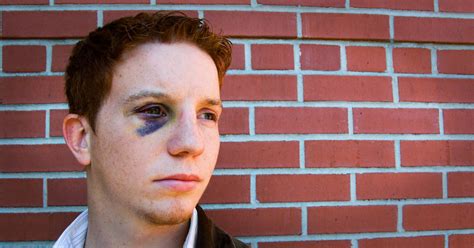 More images for how do you get a poinsettia to turn red » Black Eye: What Causes Black Eyes and How to Get Rid of Them