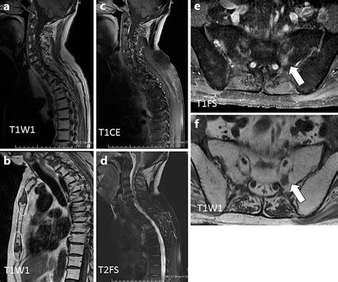 Sagittal T Weighted MRI Of The Cervical And Thoracic Spine A And Download Scientific Diagram