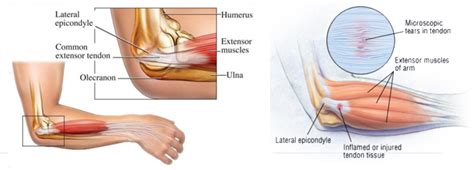 Learn what this condition feels like, and how it is diagnosed and treated. Seattle Tennis Elbow Surgeon - Office Elbow Doctors