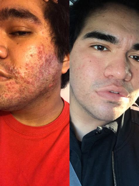 Before And After Almost 2 Years Battling Acne Ive Gotten It Under
