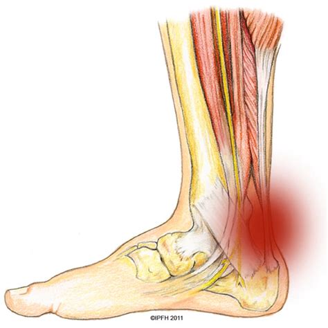 Achilles Tendon Injuries Active Care