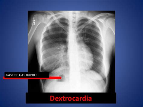 With dextrocardia situs inversus, the heart is a mirror image of its normal position. Chest x. ray interpretation and teaching