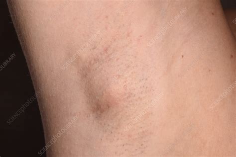 Swollen Lymph Node Stock Image C056 4406 Science Photo Library