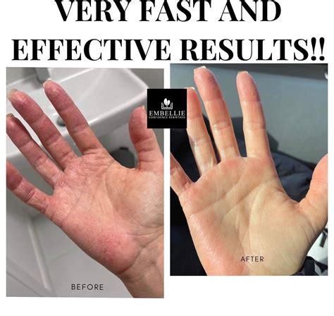 Dry Hands Before And After Ubicaciondepersonascdmxgobmx
