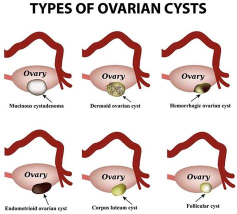 Kista Ovarium Penyebab Gejala Jenis Dan Pengobatan