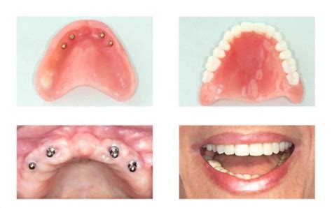 Affordable Dentures And Implants What Is The Differences