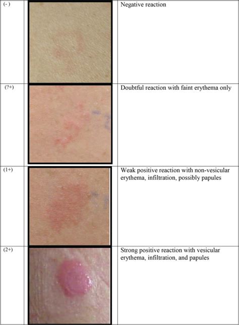 A Practical Guide To Patch Testing The Journal Of Allergy And