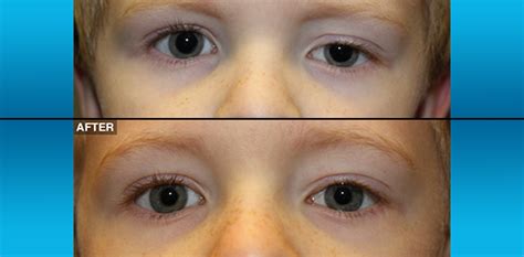 Congenital Ptosis Northwest Eyelid And Orbital Specialists Ps And Neos