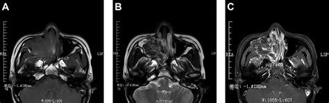 Inflammatory Pseudotumor In The Nasal Cavity And Sinuses A Case Report