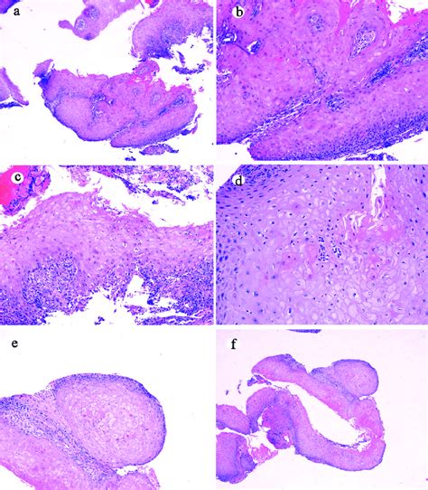 Histologic Features Of Mucosal Biopsy From The Mass Case 1 Squamous