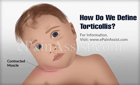 Torticollis Or Wry Neck Or Loxiacausessymptomsdiagnosistreatment