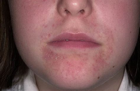 Plaques Rouges Du Visage Perioral Dermatitis Perioral Rash On Face My