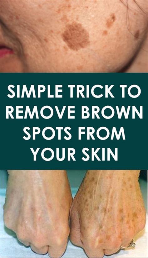 Simple Trick To Remove Brown Spots From Your Skin Health Experts Brown Spots On Hands Spots
