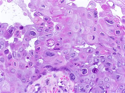 Pathology Outlines Case Of The Week 423