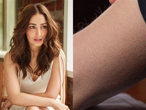 Everything You Need To Know About The Skin Disease Yami Gautam Is