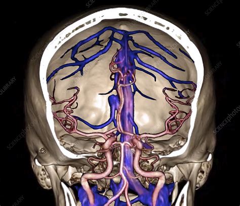 Brain Arteries And Venous Sinuses 3d Ct Angiogram Stock Image C040