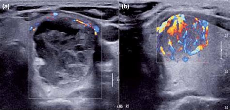 Colour Doppler Ultrasonograms Showing A A Benign Thyroid Nodule In
