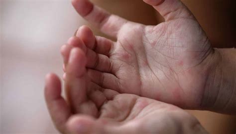 Alergia Nas Mãos Possíveis Causas Tipos Sintomas E Tratamentos