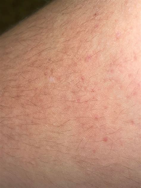 Hello Everyone I Had These Weird Red Spots On Both Of My Upper Arms