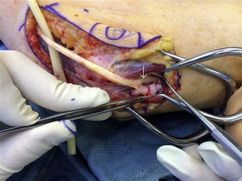 Synovial Chondromatosis Of The Elbow With Asymptomatic Ulnar Nerve