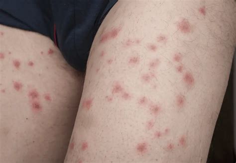 Eczema Vs Bed Bug Bites How To Tell The Difference W Pics