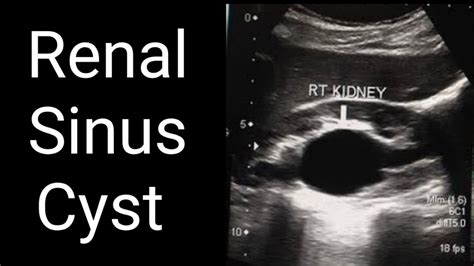 Renal Sinus Cyst Bph Simple Kidney Cyst Youtube