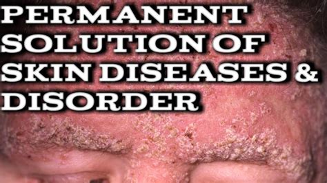 The Permanent Solution Of Skin Diseases And Disordersskin Diseases