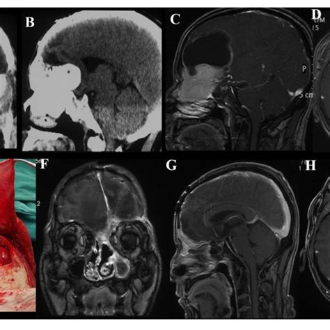 Treatment Algorithms For Skull Base Meningiomas With Extracranial