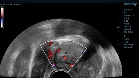 High Resolution Transrectal Prostate Ultrasound Youtube