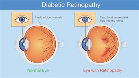 Diabetic Retinopathy Causes Treatments And Long Term Outlook 1md