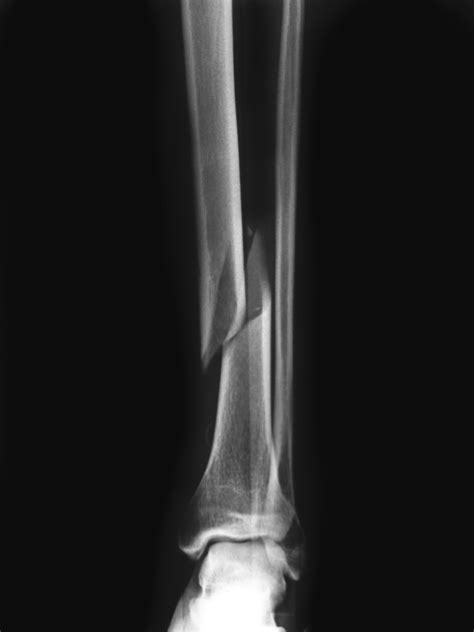 Tibia Fracture Orthopedic Centers Of Colorado