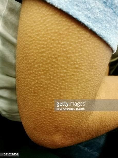 Goosebumps Arm Bildbanksfoton Och Bilder Getty Images