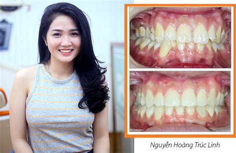 Hình ảnh Trước Và Sau Khi Niềng Răng Tư Vấn Niêng Răng
